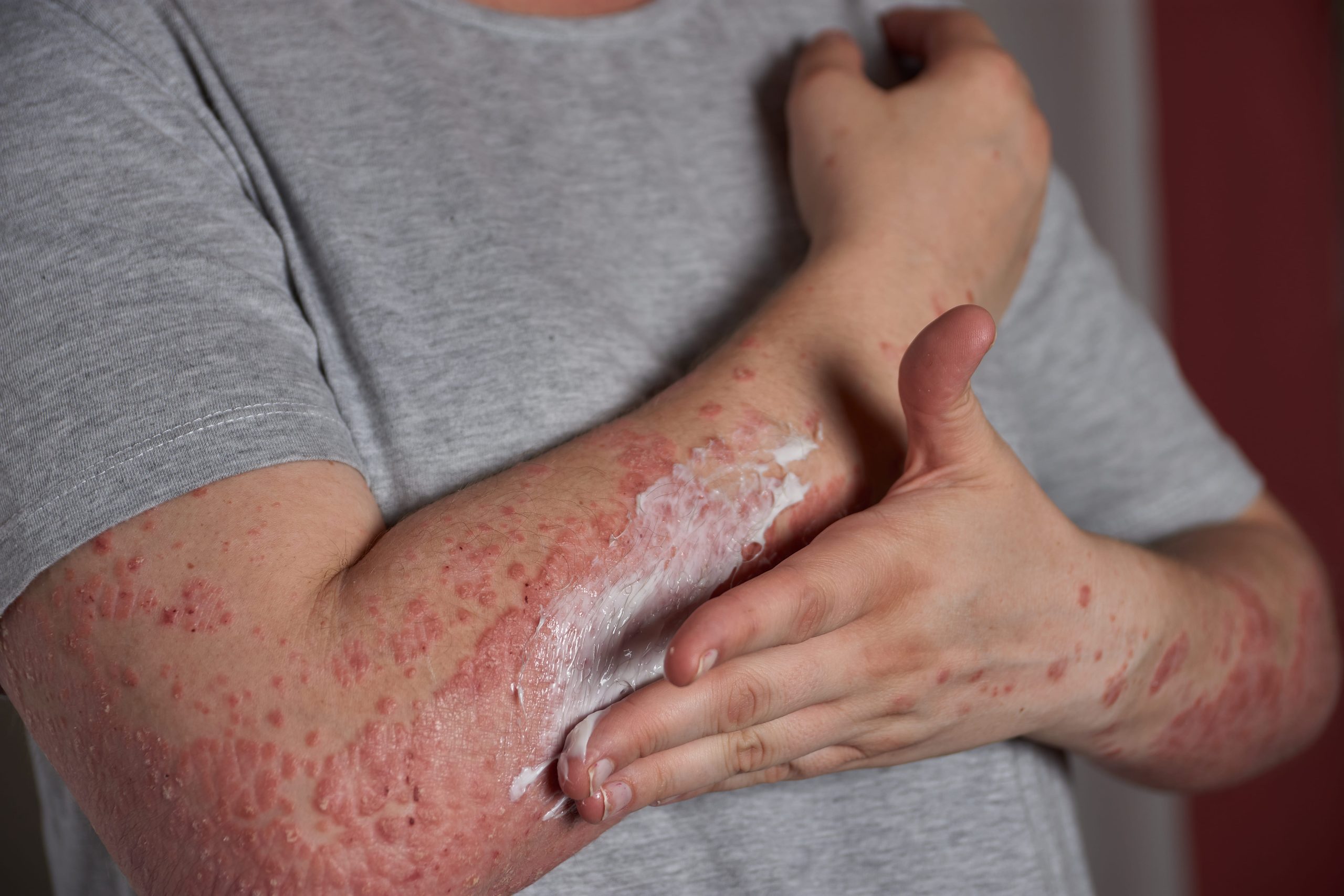 assurance emprunteur lupus érythémateux